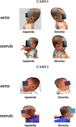 Fotografías del caso 1 y 2 en proyección lateral del cráneo del bebé antes de la frenectomía y tres semanas después de la frenectomía tras el tratamiento de fisioterapia.