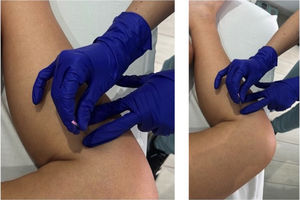 . Imagen del procedimiento de punción simulada y el procedimiento previo a la técnica de PS realizada.