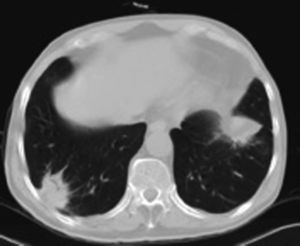 TAC torácico. Nódulos pulmonares bilaterales con broncograma aéreo, de márgenes irregulares.