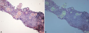 A)Biopsia renal (hijo). Parénquima cortical con depósito glomerular masivo de sustancia amiloide teñida con rojo Congo. B)Parénquima cortical con depósito glomerular masivo de sustancia amiloide observada con luz polarizada. Destaca también la fibrosis y la inflamación intersticial (×40).