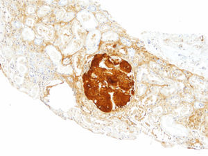 Biopsia renal (hijo). Inmunohistoquímica para apoAI, con positividad intensa en los depósitos glomerulares (×200).