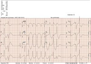 Taquicardia ventricular polimorfa. Taquicardia ventricular polimorfa. QT aumentado.