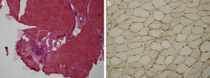 a). Estudio de hematoxilina-eosina de tejido músculo esquelético con infiltrado inflamatorio mononuclear de localización preferentemente perimisial. b). Estudio inmunohistoquímico de tejido muscular para MHC I (HLA) que muestra sobreexpresión del mismo en la membrana de las fibras musculares.