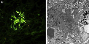 a). Estudio inmunoflurescencia de tejido renal que muestra depósitos mesangiales para IgA. b). Estudio de microscopía electrónica que muestra depósitos electrodensos en el mesangio (ver flecha blanca).