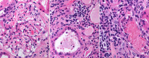 Glomérulos con hipercelularidad mesangial y expansión intersticial por células inflamatorias y eosinófilos. Inflamación tubulointersticial severa y tubulitis.