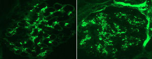 Inmunofluorescencia con anticuerpos conjugados que muestran captación mesangial granular difusa para C3 e IgA