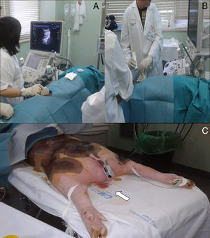 Modelo animal vivo. A) Dos alumnos visualizando el punto de punción adecuado en el riñón. B) Biopsiando al animal. C) Hematuria macroscópica tras posbiopsia renal en animal (flecha).