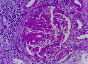 Glomérulo con necrosis fibrinoide segmentaria y semiluna fibrosa (PAS×40).