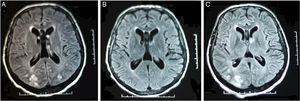 Hallazgos de la RMN: A) Hiperintensidad de sustancia blanca subcortical parietooccipital bilateral. B) De control, la RMN después de 10 días de tratamiento con resolución completa de las lesiones. C) Seis meses después del primer episodio presenta recurrencia del cuadro.