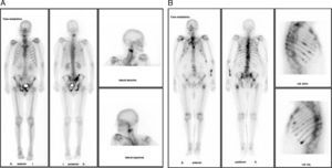 A y B) Gammagrafías óseas que muestran las lesiones óseas diseminadas en los casos 1 y 2.