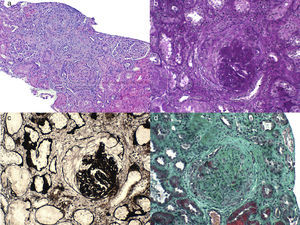 Biopsia renal: a) Hematoxilina-eosina, b) PAS, c) Plata metenamina, d) Tricrómico masson que evidencia la presencia de semilunas celulares en 12 de los 19 glomérulos valorables, con lesiones en 2 glomérulos compatibles con necrosis fibrinoide.