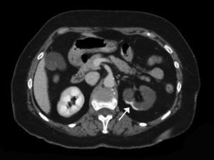Corte transversal de TC con contraste mostrando hallazgos compatibles con infarto renal con afectación de la práctica totalidad del riñón izquierdo. Se aprecia un área de hipercaptación cortical marginal (cortical rim sign) (flecha). La extensión de daño en este caso sería de 3/6 (50% del total del parénquima renal).