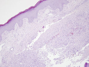 Biopsia cutánea. Se observan áreas de necrosis extensa en dermis.
