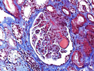 Acute TMA showing thrombosis at glomerular capillaries and mesangiolysis (Masson's trichrome stain).