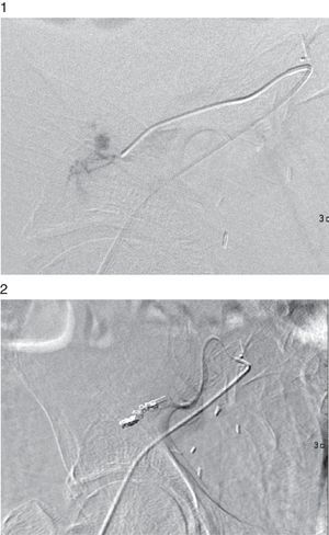 Arteriografía del injerto renal con extravasado de contraste en rama distal. Embolización selectiva de rama distal de arteria del injerto con desaparición del extravasado.