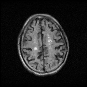 FLAIR MRI (December 2011) which showed hyperintense lesions compatible with microhemorrhages.