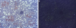 Histological examination of the kidneys. (A) Glomerular nodular deposits of amyloid stained with Congo red. (B) Amyloid showing typical apple-green birefringence under polarized light.