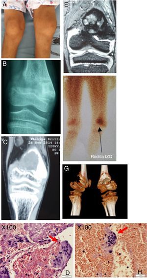 Descripción de la lesión ósea de tumor pardo en el paciente. A) Genu-varo marcado en miembro inferior izquierdo con edema leve. B) Rx AP de rodilla izquierda, fractura incompleta zona de epífisis distal de fémur izquierdo, con imagen radiopaca infiltrante. C) TC en misma zona anatómica, lesión sólida osteolítica de 40×33mm en la epífisis distal del fémur, el cartílago de crecimiento impresiona respetado. D) Muestra histológica procesada, se denota gran cantidad de células multinucleadas. E) RMN en misma zona anatómica, proceso ocupativo heterogéneo irregular metafisario con compromiso de porción ósea y de la cortical con epicentro en la porción metafisaria femoral distal de 35×33mm y con la presencia de líquido perilesional, no compromete otras estructuras. F) Estudio de gammagrafía con rastreo corporal total con 99mTc-sestaMIBI muestra captación de radiofármaco en metáfisis distal de fémur izquierdo. G) Visión tomográfica en 3 dimensiones, vista lateral y posterior de epífisis distal de fémur izquierdo. H) Identificación precisa de la célula gigante multinucleada, característica del tumor pardo óseo. Fuente: Elaborado por Juan Miguel Alemán I; Tomado del Centro de Imágenes del Hospital José Carrasco Arteaga y Centro de Patología del Hospital José Carrasco Arteaga.