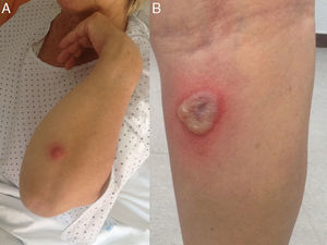 Lesiones cutáneas en el brazo (A) y en la parte posterior de la pierna (B), correspondiente a ectima gangrenoso.