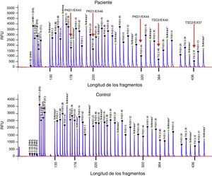 Deleción de genes contiguos TSC2/PKD1. Diagrama de resultados del análisis de deleciones/duplicaciones mediante la técnica de Multiplex Ligation-dependent Probe Amplification (MLPA) del paciente con SGC (panel superior) y de un individuo control (panel inferior). Las flechas rojas indican la deleción de los exones 43 al 46 del gen PKD1 (secuencias de referencia de GenBank: NM_001009944.2; NP_001009944.2): c.11713-?_12909+?del; p.(Ser1555fs)) y los exones 37 al 42 del gen TSC2 (NM_000548; NP_000539): c.4663-?_5421+?del; p.(Val3905fs)). Nomenclatura según la Human Genome Variation Society (http://www.hgvs.org/mutnomen/).