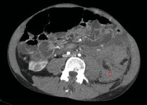 El sangrado descrito en la figura 2 conforma un voluminoso hematoma distal al polo renal inferior (C).
