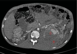 Aumento de tamaño del hematoma retroperitoneal izquierdo (B) y del aneurisma visible en tercio superior del riñón respecto al estudio previo (C).
