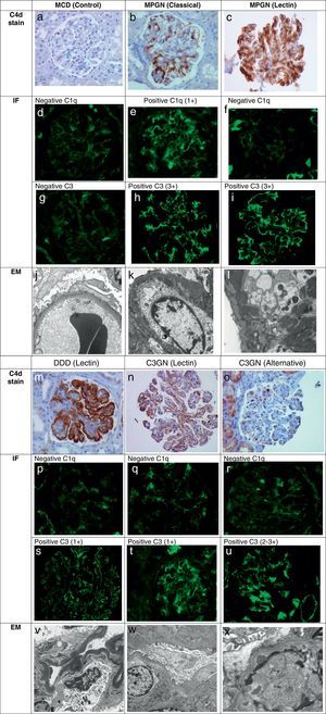 Biopsy classification involving the complement cascade based on C4d stain, IF, and EM. The light microscopy (not shown) that is consistent with a membranoproliferative pattern along with immunofluorescence (IF) and electron microscopy (EM) pattern defines MPGN and C3G. By using C4d immunohistochemistry, C1q and C3 on IF, the involvement of a particular complement pathway can be suggested. Minimal change disease (MCD) biopsy serves as a control. There is no detection of glomerular capillary loop C4d stain (a), no presence of glomerular C1q (d) or C3 (g) by IF, and on EM (j) there is podocyte effacement with no electron dense deposits. MPGN (classical) phenotype shows predominant global capillary loop C4d stain (b), positive glomerular C1q (e) and positive C3 (h) on IF. The EM (k) shows presence of subendothelial electron dense deposits. MPGN (lectin) phenotype shows predominance of global capillary loop and mesangial C4d staining (c), negative glomerular C1q (f) and positive glomerular C3 (i) on IF. The EM (l) here shows presence of large subendothelial and mesangial deposits. DDD (lectin) phenotype shows dramatic linear global capillary loop C4d stain (m), negative glomerular C1q (p), and positive glomerular C3 (s) on IF. The EM (v) here shows the characteristic dark, linear osmophilic intramembranous electron dense deposits. C3GN (lectin) phenotype shows predominance of global capillary loop C4d stain (n), negative glomerular C1q (q), and positive glomerular C3 (t) on IF. The EM (w) here shows subendothelial deposits. C3GN (alternative) phenotype shows the no detection of capillary loop C4d stain, negative C1q, and positive C3. The EM shows (x) subendothelial and mesangial deposits.