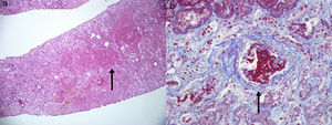 Biopsia renal. a. Múltiples focos de necrosis isquémica cortical, que respeta parcialmente el área subcapsular y no se extiende a las zonas más profundas (flecha). b. Trombos arteriales en distintos estadios de organización e imagen de hiperplasia en «capas de cebolla» de la íntima sugestiva de microangiopatía trombótica (flecha).