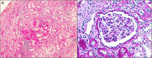 Biopsia renal de un paciente con mutación en el gen UMOD. A) Fibrosis intersticial, atrofia tubular focal, esclerosis glomerular y leve infiltrado inflamatorio crónico (tinción H-E, ×4). B) Glomérulo sin alteraciones morfológicas ópticas (tinción PAS, ×20).