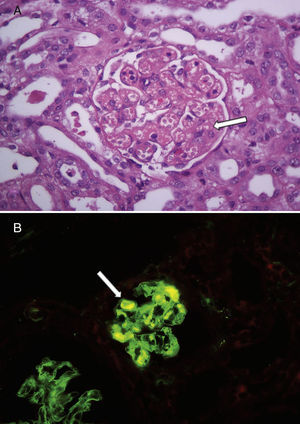 Hallazgos en la histología renal de un niño con síndrome urémico hemolítico asociado a diarrea sin trombocitopenia. A: glomérulos renales con dilatación de capilares y mesangiolisis (flecha blanca). Hematoxilina y eosina, ×400. B: la inmunofluorescencia mostró trombos de fibrina en algunos glomérulos (flecha blanca), ×400.