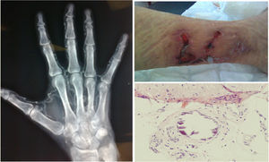 Lesión cutánea en miembro inferior secundaria a calcifilaxis (arriba derecha). Lesiones histológicas en el tejido celular subcutáneo con áreas de calcificación, algunas de ellas perivasculares, compatibles con calcifilaxis (abajo derecha). Radiografía de mano izquierda en la que se observan calcificaciones vasculares (izquierda).