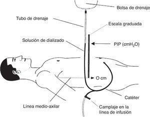 Esquema de medición de la presión intraperitoneal (PIP) utilizando una regla y la línea de drenaje de una bolsa de DP con sistema en Y. Fuente: Mathieu et al.7, con permiso.