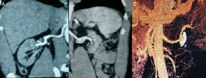 A) Arteria renal derecha sin signos de estenosis y riñón derecho de tamaño conservado. B) Arteria renal izquierda sin signos de estenosis; aneurisma de 2cm de diámetro; riñón izquierdo atrófico. C) Reconstrucción 3D del aneurisma de pared calcificada y trombosada.