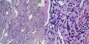 A) Signos histológicos claros de nefropatía intersticial crónica caracterizada por dilatación tubular rica en material de aspecto coloide que ofrece la imagen típica de «tiroidización renal». B) En pequeños vasos y en región medular, se observa proliferación miointimal con oclusión de su luz e inicio de proliferación de la capa media con formación incipiente en «capas de cebolla».