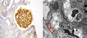 (a) Active lupus nephritis ISN/RPS class III (A), NIH activity index (4/24) NIH chronicity index (3/12) showing strong diffuse global immunostaining for podocalyxin 4+ (original magnification ×400). (b) An electron micrograph for the same case showing minimal fusion of podocyte foot processes (arrows) (negative magnification ×2800).