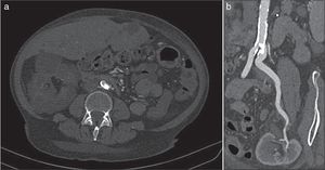Angiotomografía computarizada. a. En el corte transversal se observa una lesión calcificada intraluminal en el origen de la arteria iliaca común izquierda. b. En la reconstrucción multiplanar se observa permeabilidad sin estenosis en la arteria renal del injerto trasplantado.