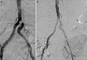 Arteriografía intraoperatoria. a. Se objetiva lesión calcificada intraluminal en el origen de la arteria iliaca común izquierda. b. Control post-implantación de los stents recubiertos sin estenosis residual.