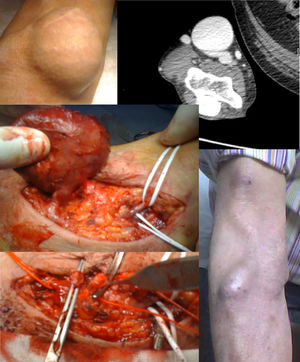 Caso 3: FAV humerocefálica. Resección y reconstrucción con vena mediana antecubital.
