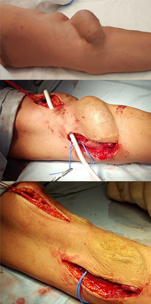 Caso 4: FAV humerocefálica. Exclusión del aneurisma con puente humerocefálico de PTFE.