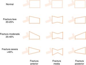 Representación esquemática de la aproximación semicuantitativa de Genant para la medición visual de deformidades vertebrales. Normal = 0; leve = 1; moderada = 2; severa o grave = 3; dudosa = 0,5. El diagnóstico de fractura vertebral es frecuentemente casual (fractura morfométrica) aunque puede ser clínico. Se basa en la pérdida de altura del cuerpo vertebral superior al 20% en cualquiera de los segmentos vertebrales. El cálculo se realiza según la fórmula ([altura posterior el cuerpo vertebral– altura menor]/altura posterior) x100115,152.