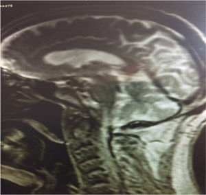 RMN del cerebro de paciente afecto de síndrome de Guillain-Barré.