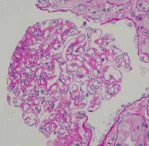 Renal biopsy (haematoxylin and eosin, ×400), showing endocapillary hypercellularity with immune cell infiltration (arrow head).
