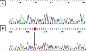 Resultado del estudio genético con la variante c.287C>T (p.Ser96Leu) identificada en el exón 2 de la paciente B) comprado con un caso control A).