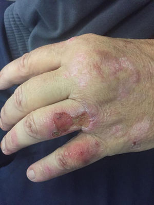 Lesiones en dorso de la mano izquierda.
