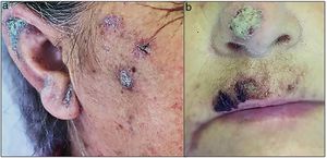 Lesions in the face: erythematous-scaly plaques (a and b).