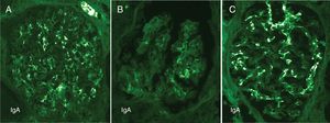 Contrasting features of IgA dominant IRGN and idiopathic IgAN. Mesangial and capillary wall coarse granular deposits are prominent in exudative IgA IRGN (A) and less so in resolving IgA IRGN (B). These immunofluorescence patterns contrast with the largely mesangial deposits of IgA in idiopathic IgAN (C).
