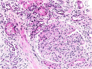 Diffuse global proliferative glomerulonephritis with lobulation of glomeruli (HE, 20×).