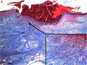 Tinción con tricrómico de Masson 40×. A) Epidermis con acantosis que rodea un tapón compuesto por detritus celulares, queratina y células inflamatorias. B) Presencia de fibras de colágeno, que se introducen desde la dermis hacia la epidermis.