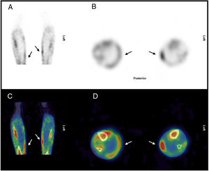 SPECT óseo, cortes coronal (A) y axial (B). SPECT/TC óseo, cortes coronal (C) y axial (D). Se evidencian calcificaciones heterotópicas en región medial de ambas piernas (flechas).