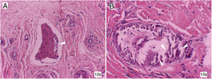 Histología con tinción de hematoxilina y eosina de las lesiones cutáneas. Calcificación perineural (A) y calcificación de vaso de mediano calibre (B) (flechas). Estos hallazgos son compatibles con la calcifilaxis.
